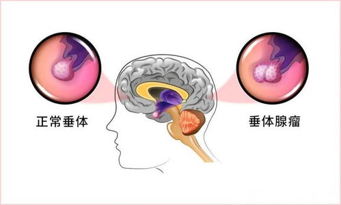 垂体瘤经鼻蝶术后鼻腔愈合时间及清洁护理指南